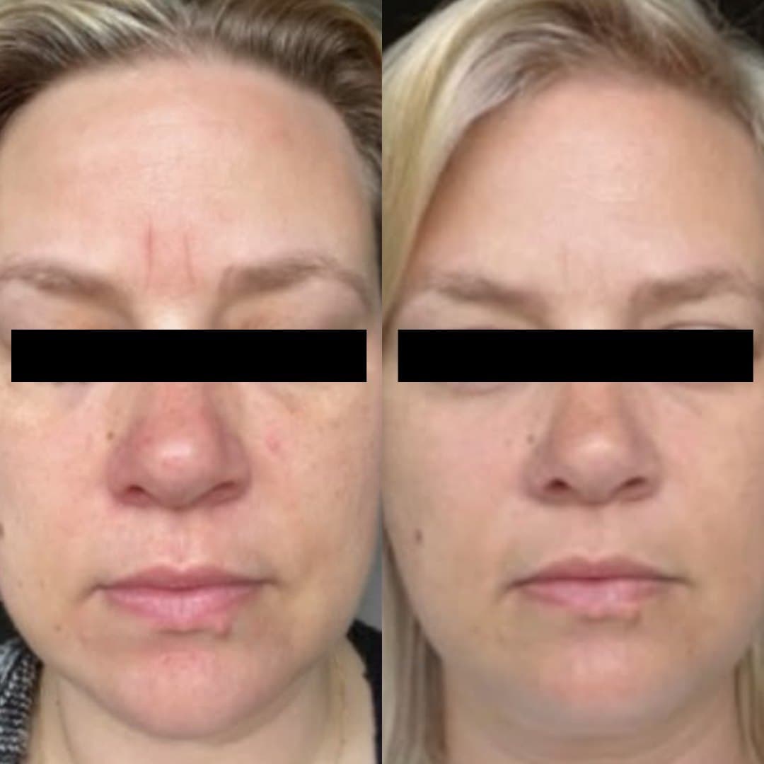 Microneedling before and after on a client in Sutton: softer lines across the forehead and between the brows, and calmer redness around the nose and cheeks