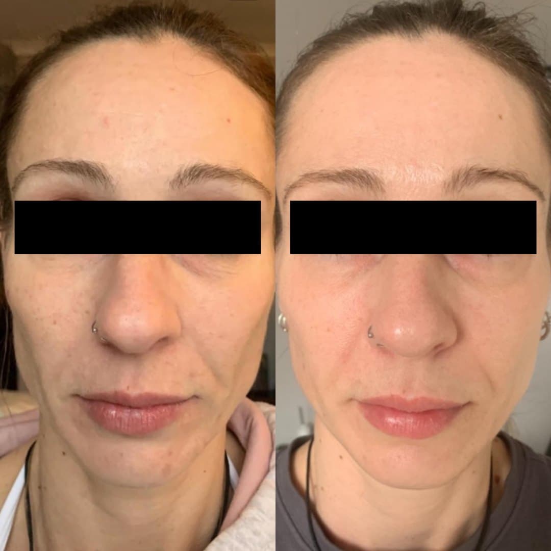Microneedling before and after on a client in Sutton: smoother skin texture on the cheeks and jaw